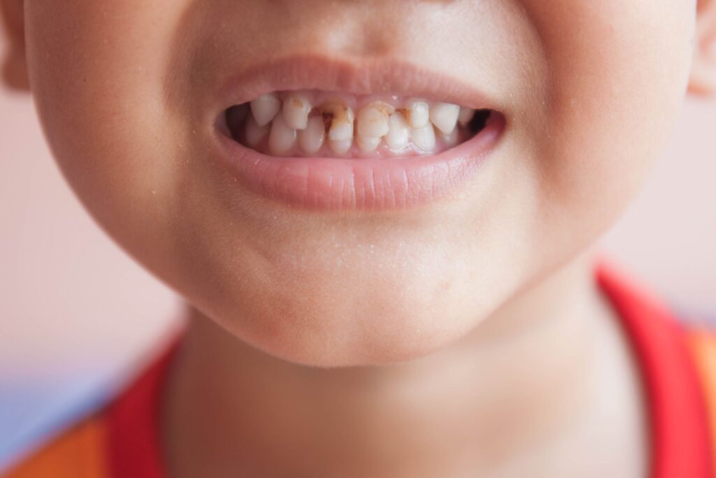 Children Cavities Treatment